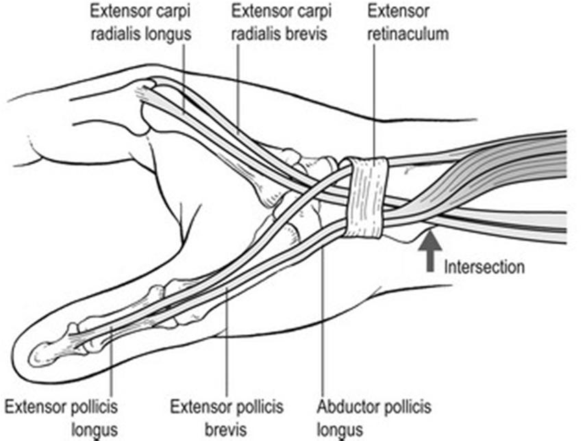 Intersection syndrome Proximal to Dequervain s Tenosynovitis of first (APL/EPB) and
