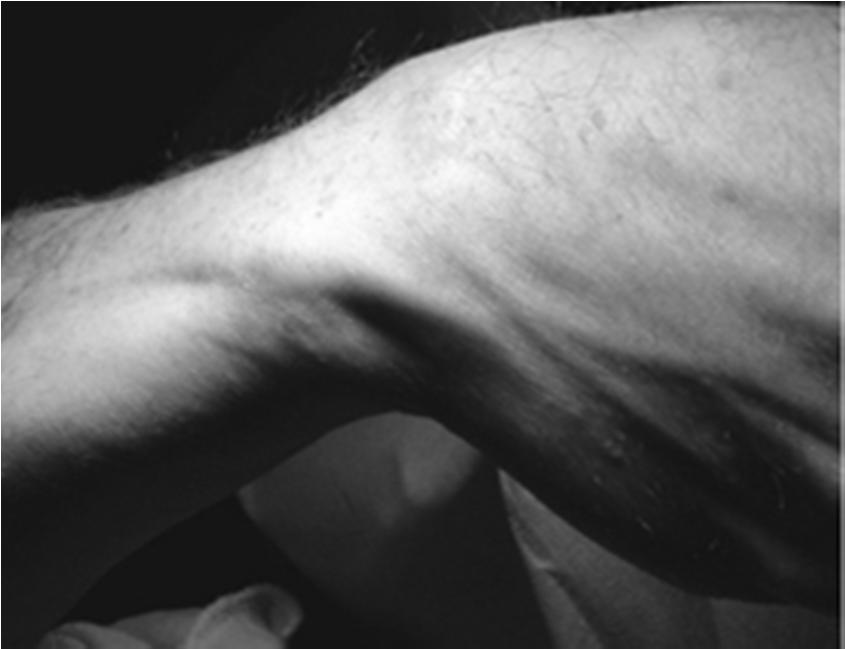 Clinical Examination ECU FUSS maneuver: wrist flexion ulnar deviation, supination