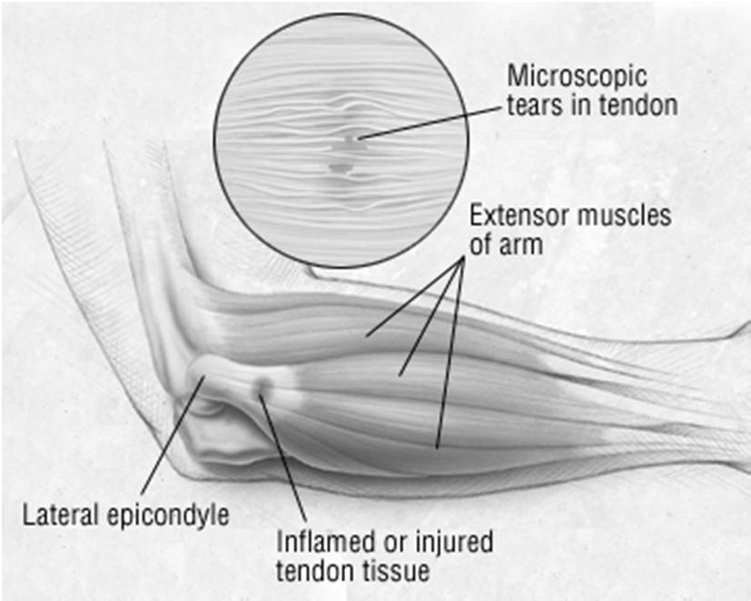 Lateral Epicondylitis Anatomy Pathologic change within ECRB tendon Angiofibroblastic dysplasia Undersurface of tendon is avascular to 2 3cm distal to insertion High stress area
