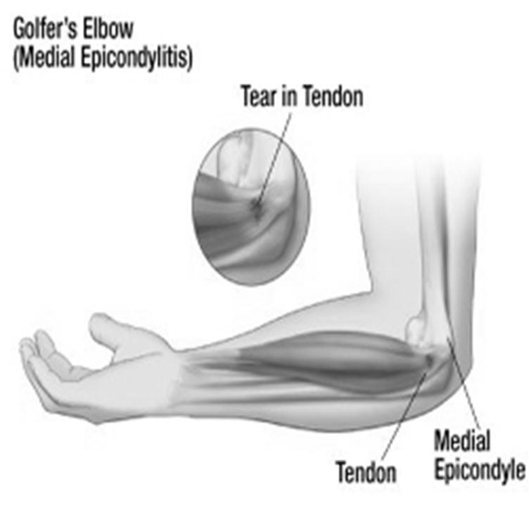 Medial Epicondylitis Examination Tender over medial epicondyle Pain with resisted wrist flexion Differential diagnosis Ulnar neuropathy (possible subluxation) Fracture