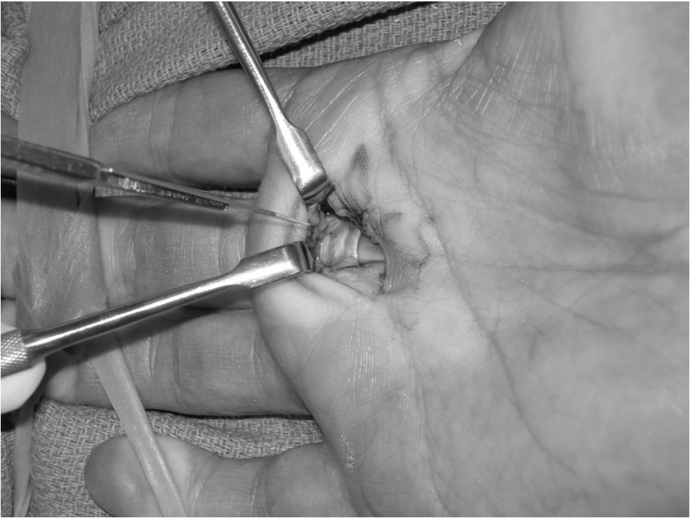 Trigger digit Surgical treatment Release Open Percutaneous Equal Efficacy