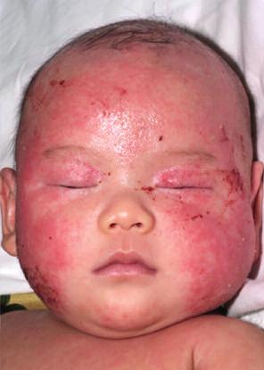 The patient must report an itchy skin condition (or parental report of scratching or rubbing in a child) in the last 12 months, plus 3 or more of the following: history of involvement of the skin