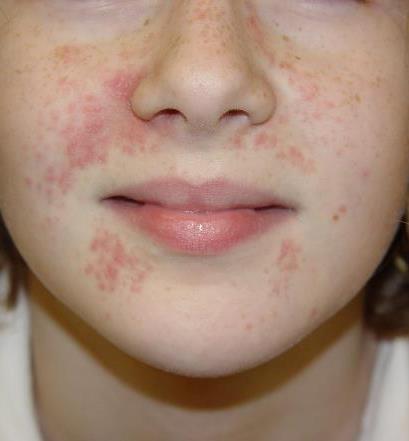 PERIORAL DERMARTITIS Children and Adult Women Around the mouth and sometimes eyes Red papules with
