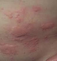 URTICARIA- HIVES All ages Red itchy welts May get more welts with