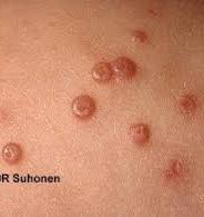 MOLLUSCUM CONTAGIOSUM Infants to young adults Viral infection Spread by