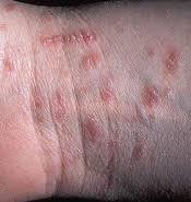 SCABIES Any age Itchy papules from the neck down (except infants) Most