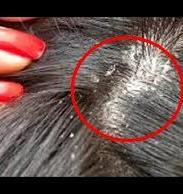 LICE Pediculosis- any age Three types: head, body and genitals Feed on blood
