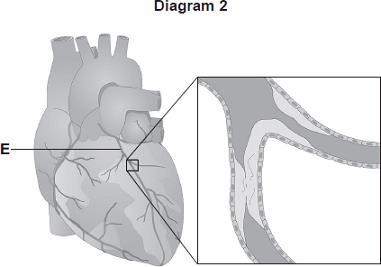 (4) (b) Diagram 2 shows the blood vessels that supply the heart muscle. Part of one of the blood vessels has become narrower. (i) Name blood vessel E.