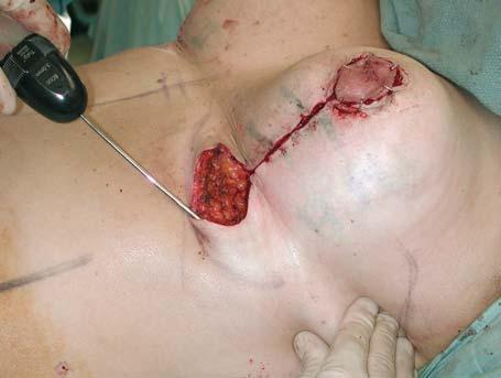 Prior to closure of the lower end of the vertical scar liposuction of the lateral chest wall and axillary tail is performed Fig. 4.