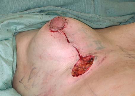 The purse-string suture has been tied Management of the Lower End of the Vertical Scar Fig. 4.24.