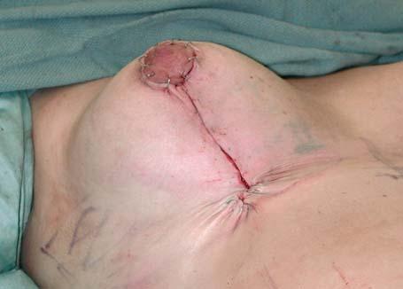 is the management of the excess skin at the lower end of the vertical scar.