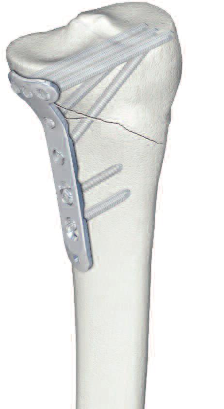 LCP Medial Proximal Tibial Plate 4.5/5.0. Part of the Synthes LCP periarticular plating system. The LCP Medial Proximal Tibial Plate 4.5/5.0 is part of the Synthes LCP periarticular plating system, which merges locking screw technology with conventional plating techniques.