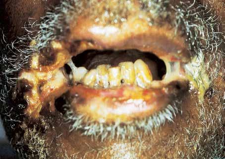 Figure 4 Severe involvement of the mucocutaneous junction with necrosis of the oral commissures is evident in this patient with bullous pemphigoid.