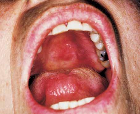 Figure 9 These erosive lesions with an erythematous base that appeared on the hard palate were caused by phenobarbitol. The ulceration results from liquefaction necrosis of the oral mucosa.