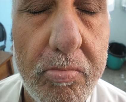 This patient re-presented after 2 weeks with new lesions on the lips and chin. Examination revealed yellowish crusted erosions over the lips and moustache area.