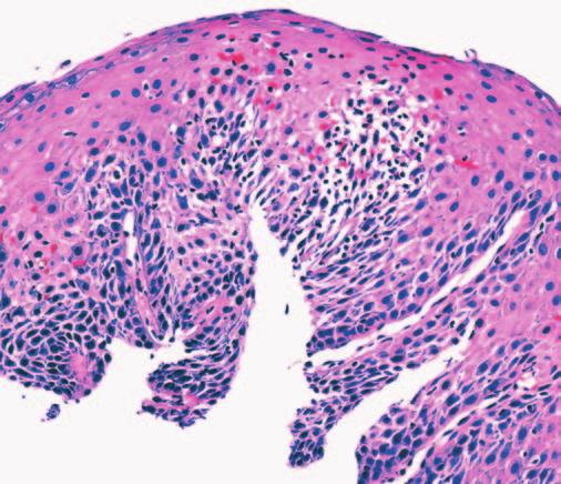 Anatomic Pathology / Original Article Esophageal biopsy specimens with significant intraepithelial lymphocytosis are often also spongiotic, resembling acute spongiotic dermatitis, such as allergic