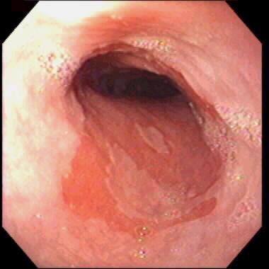 Barrett s Esophagus Replacement of normal squamous mucosa Specialized Intestinal Metaplasia