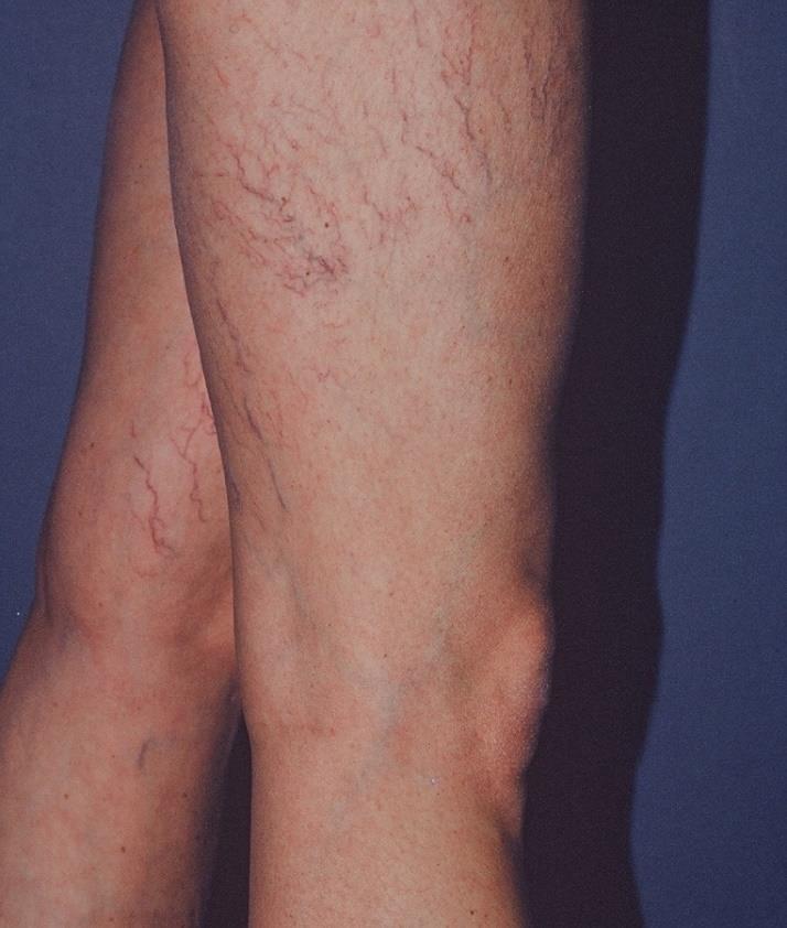 Lateral Subdermic Plexus Very common, especially in women Superficial veins