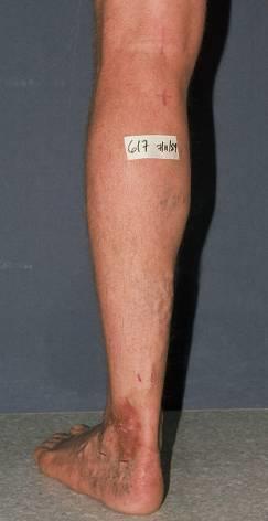Less frequent than Great Saphenous involvement Varicosities may be seen on the posterior calf and