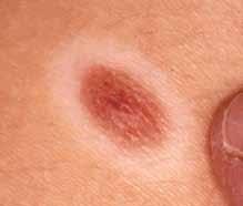 Photo Quiz Answers Running Do You Head Know Goes Your Here Nevi To Fill (Cases begin on page 217d) XXX) This is nevus lipomatosus; the group of soft yellow nodules have coalesced to form a plaque