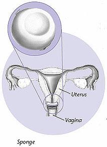 Less spermicide is needed than with a diaphragm, and it does not need to be added before each act of sex. After sex, the cap should be left in place for 6 hours but not longer than 48 hours total.