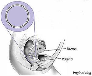 Vaginal Ring. The ring is a flexible plastic ring that you insert into the upper vagina.