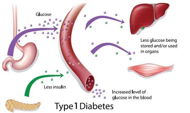 Type I: insulin-dependent diabetes It is an autoimmune disorder in which the immune system destroys the β-cells of the