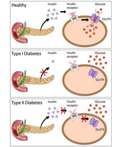 Type II: insulin-independent diabetes It is caused by a reduced responsiveness of insulin target cells due to some change in the