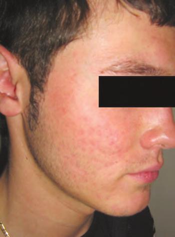 Papulopustuloses acne with scar development on early treatment with isotretinoin tazei alcaline, colesterolului ºi trigliceridelor.