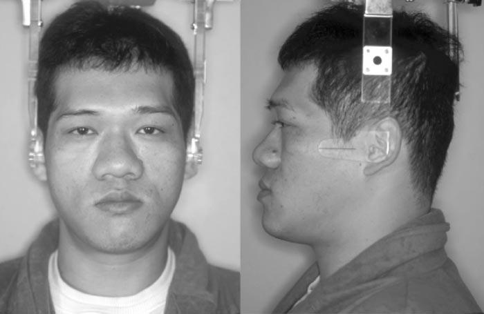 126 YAGI, KAWAKAMI, TAKADA FIGURE 2. Initial facial photographs. FIGURE 3. Initial (A) lateral cephalometric radiograph and (B) its tracing.
