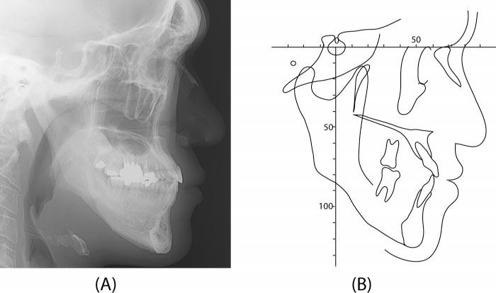 130 YAGI, KAWAKAMI, TAKADA FIGURE 10. (A) Lateral cephalometric radiograph and (B) its tracing at the retention phase. FIGURE 11. Intraoral photographs at the retention phase.