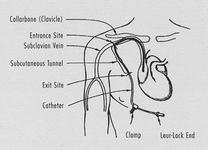 Tunneled Central Venous Catheters (Broviac, Hickman, Groshong,) A tunneled catheter is a tube made of a special rubber-like material tunneled under the skin.