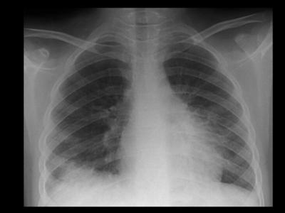 Figure 2 Figure 2: Chest X-Ray AP supine showing a right basal subpleural triangular focus of consolidation as well as prominent interstitial markings.