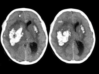 Figure 4 Figure 4: CT head showing multiple foci of haemorrhage in the supratentorial neuroparenchyma, with the largest focus located in the right internal capsule and basal ganglia.