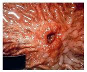 5m long Borders small intestine Receives all indigestible matter from small intestine