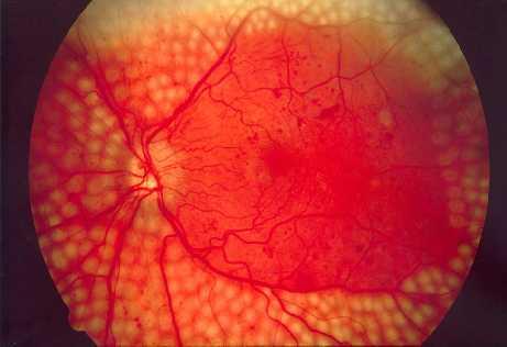 Chronic Complications of diabetes mellitus Angiopathy Chronic elevation of blood glucose level leads to damage of blood vessels The endothelial cells lining