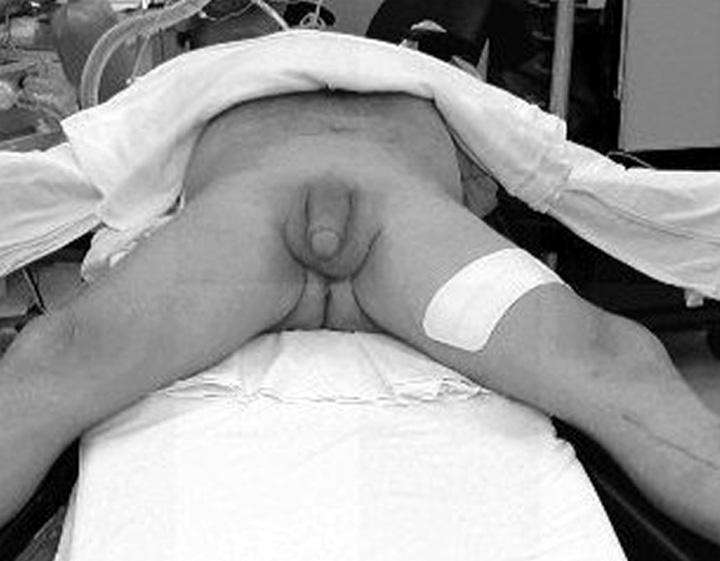 Bulbous Urethra Cuff Placement - Transverse Scrotal Approach Complete the following steps to place the cuff at the scrotum: 1.