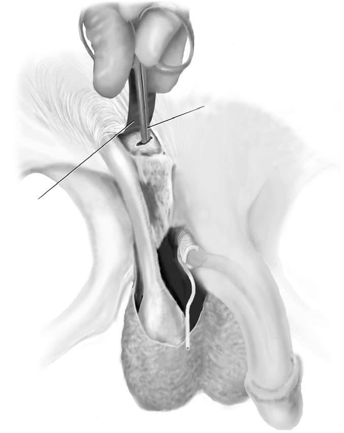 Place the PRB in the retro-pubic space in a similar fashion to a penile implant reservoir by locating the inguinal ring and piercing the transversalis fascia.