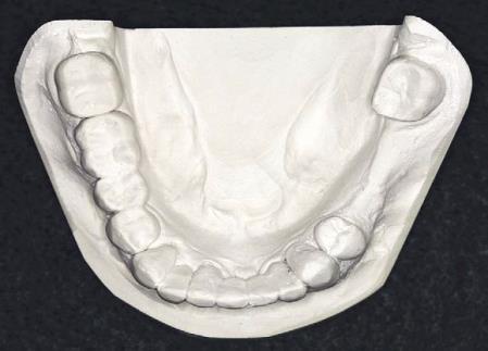 Class II - unilateral edentulous area located posterior to all remaining teeth.