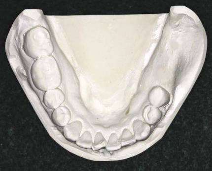 Class IV - a single, but bilateral (crossing the midline) edentulous area located anterior to remaining teeth.