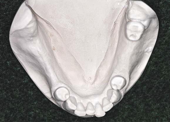 Rule 4: If the second molar is missing and not be replaced, it is not considered in the classification.