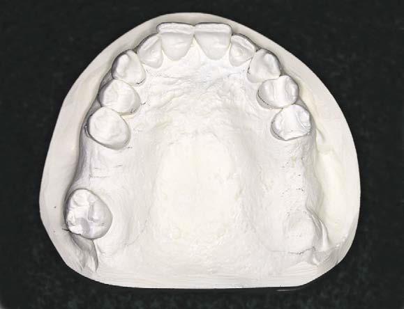Rule 6: Edentulous areas other than those determining classification are called modification spaces.