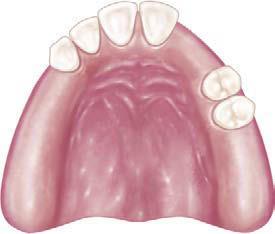 Thus the Class II partial denture rightly falls between the Class I and the Class III, because it embodies design features common to both.