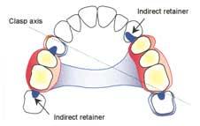 The pie charts indicate the percentage of prosthodontists preferring 2, 3 or 4 clasps for each of the Kennedy classes.