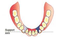 If however, there are very few teeth remaining, but rests on them would produce a support axis which forms a tangent to the residual ridge, tooth support can usually be employed to advantage and the