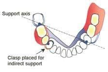 The denture rotates about the support axis (an imaginary line passing through the occlusal rest adjacent to the saddle and the most distal rest on the other side of the arch) so that denture