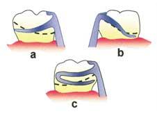 might create an occlusal interference (Fig. 7b). There are exceptions to this statement particularly if the tooth has a long clinical crown.