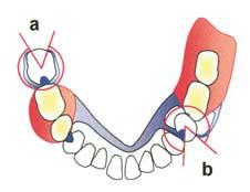 In the molar region this distribution of undercuts is associated with the tilt of the teeth creating the Curve of Monson.