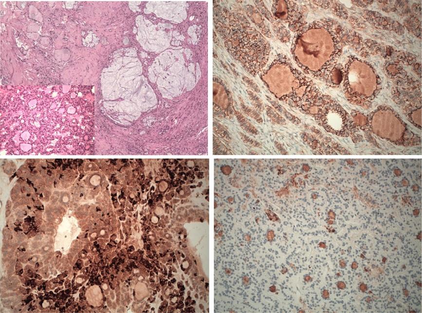 Selvggi et l. World Journl of Surgicl Oncology 2012, 10:93 Pge 3 of 5 c d Figure 2 Histologicl nd immunohistochemicl profile of thyroid type crcinom in SO.