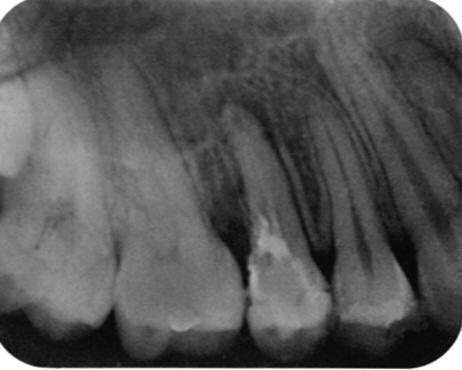 Clinical a b Figure 1a: Pre-operative radiograph. Figure 1b: Bleeding from the perforation site. c Figure 1c: Perforation site was repaired with light-cured glass ionomer.